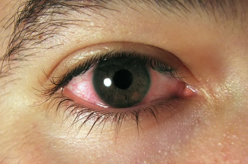 Причины возникновения красных сосудов в глазах